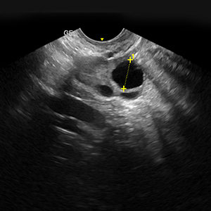 Follicular Monitoring