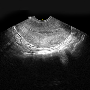 Thin Endometrium