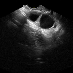 Follicular Monitoring