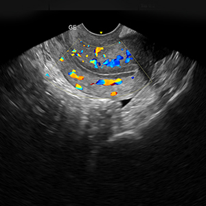 Thin Endometrium