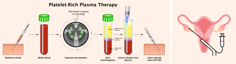 Ovarian Rejuvenation