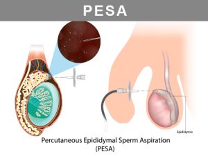 PESA