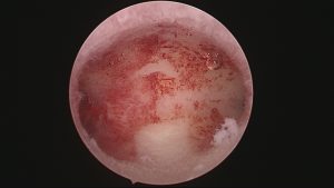 Hysteroscopy