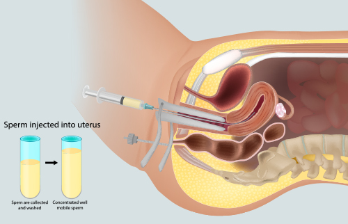 IUI Treatment – Intrauterine Insemination